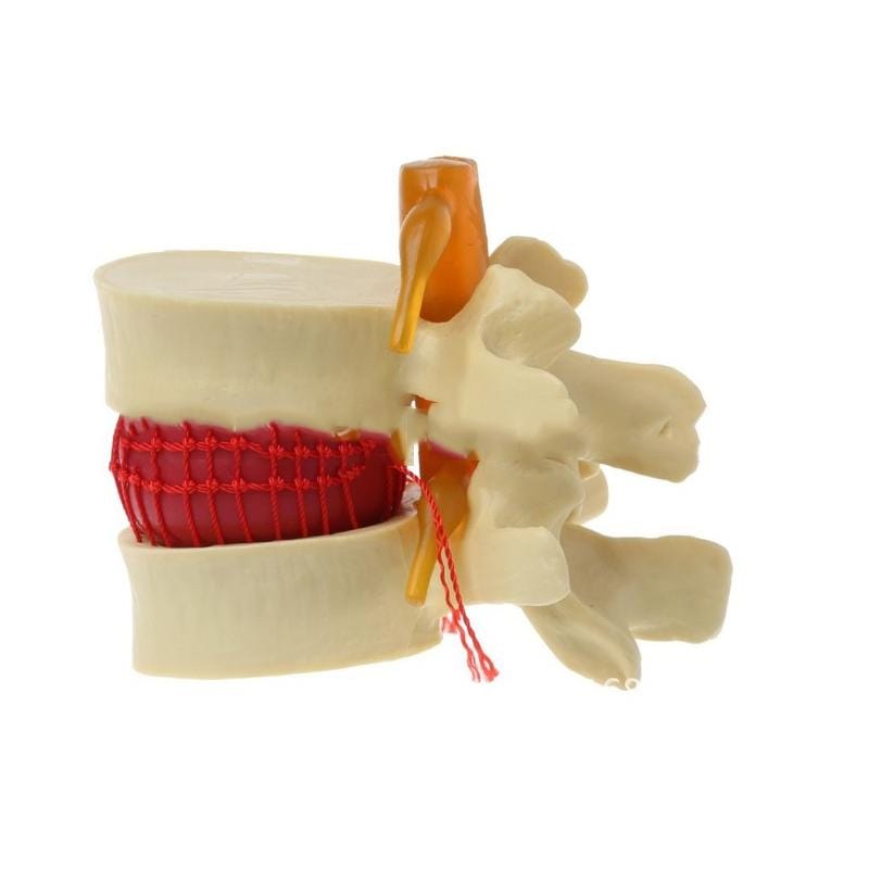 Human Lumbar Disc Herniation Demonstration Model Orthopedic Spine Model (Yellow)