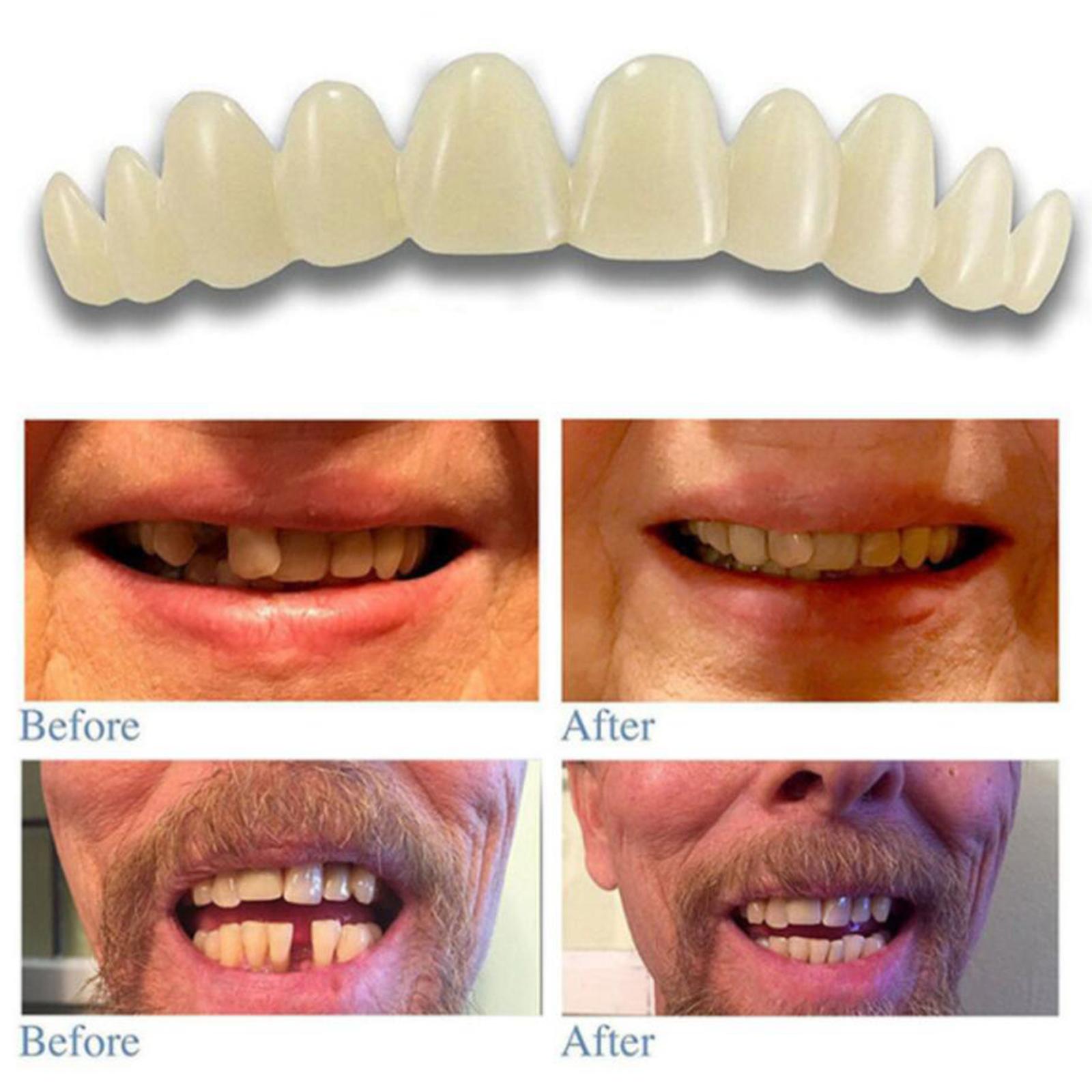 Moldable Teeth Veneers with Adhesive Fitting Beads Temporary False Teeth