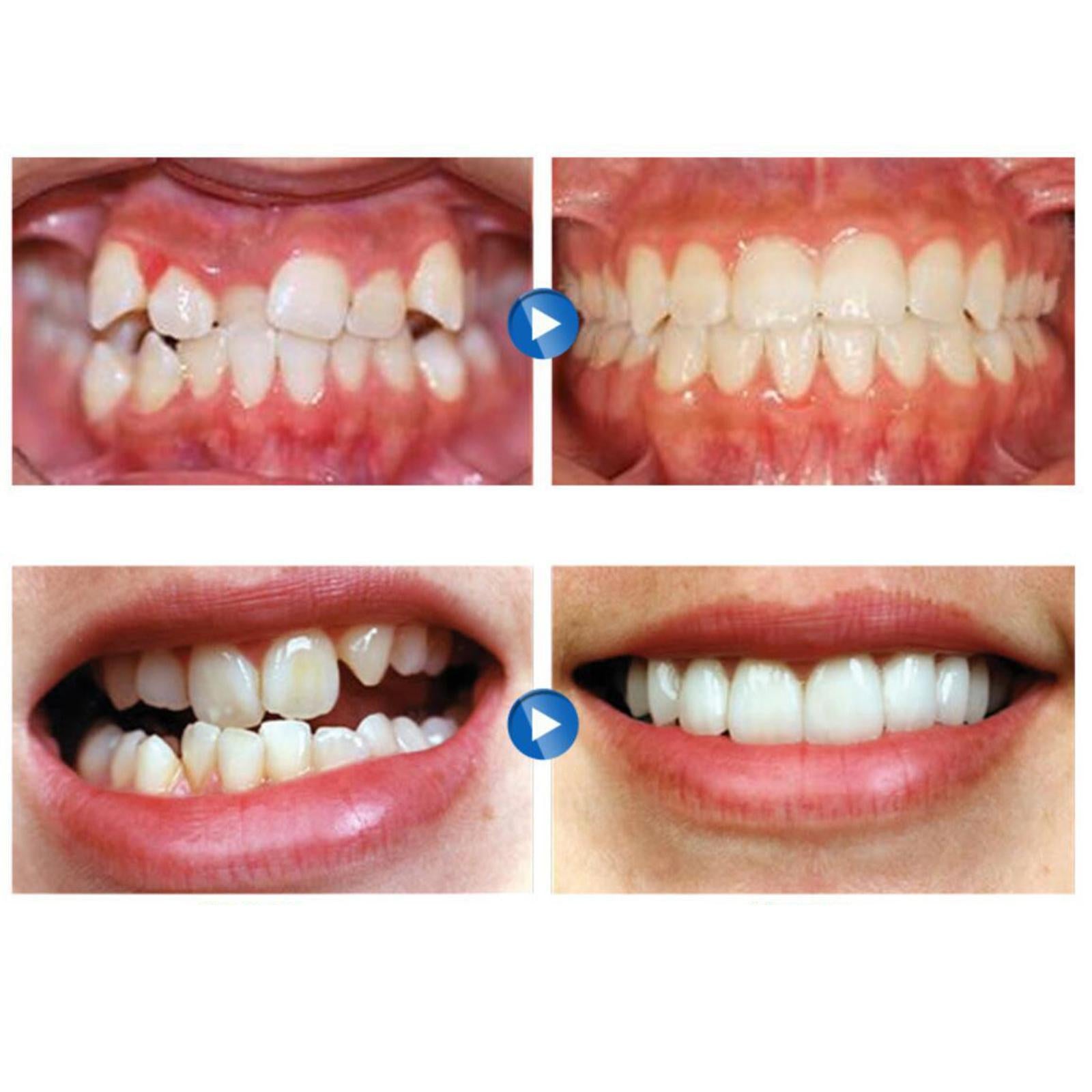 Dental Mouth Guard for Grinding Teeth Tooth Protector Night Guard Purple