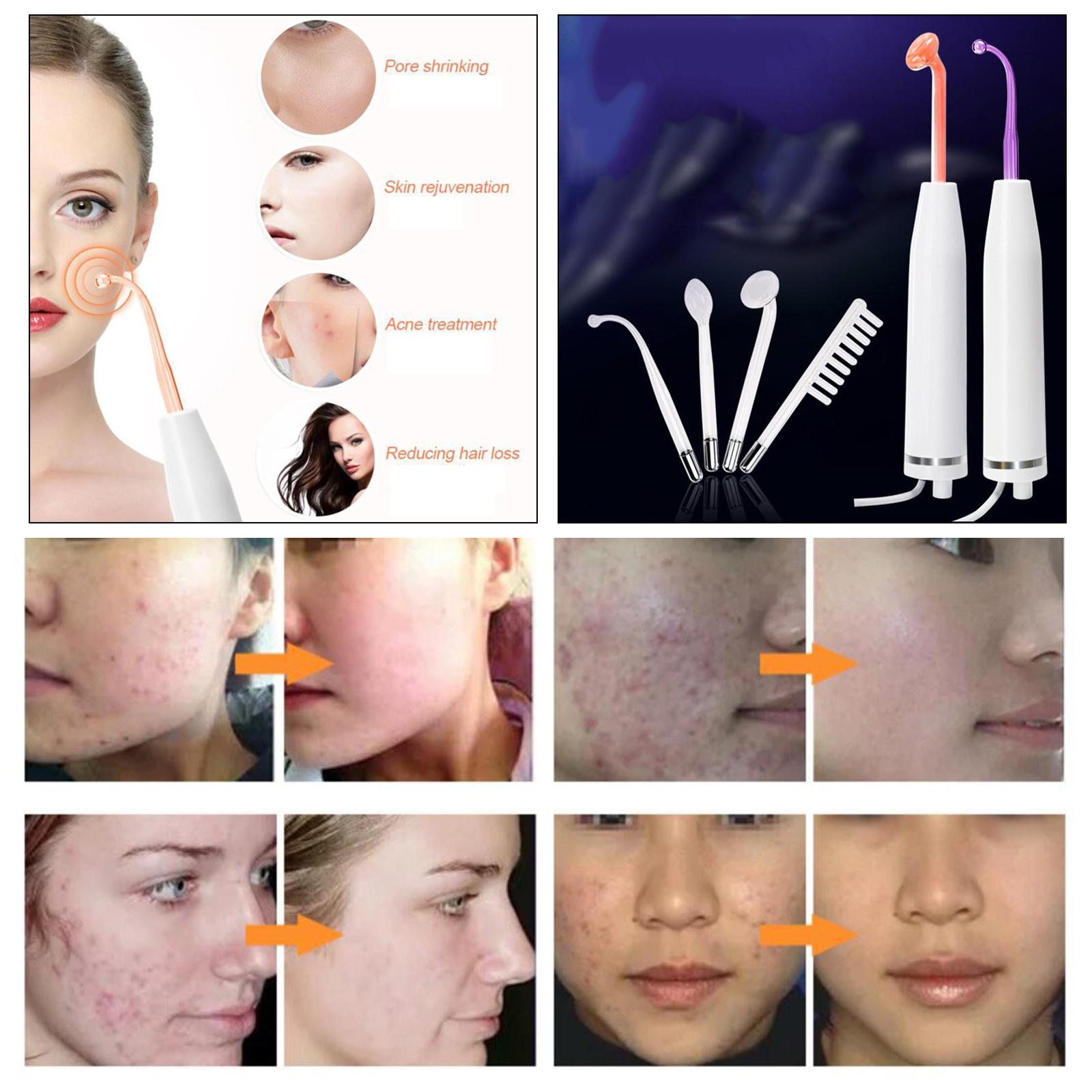 Portable 4 in 1 High Frequency Skin Tightening Facial Machine Home SPA White