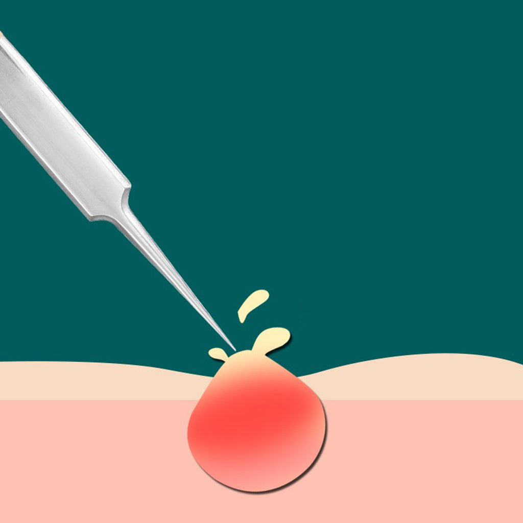 Acne Blackhead Removal Kit Extractio Kit for Zit Removing Whitehead Popping 8 Pieces