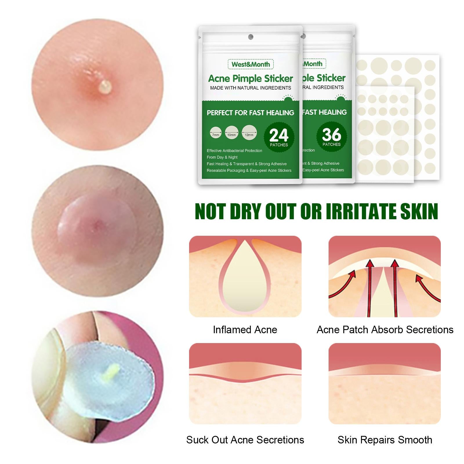 Pimple Acne Treatment Stickers Perfect for Fast Easy-Peel Pack of 36