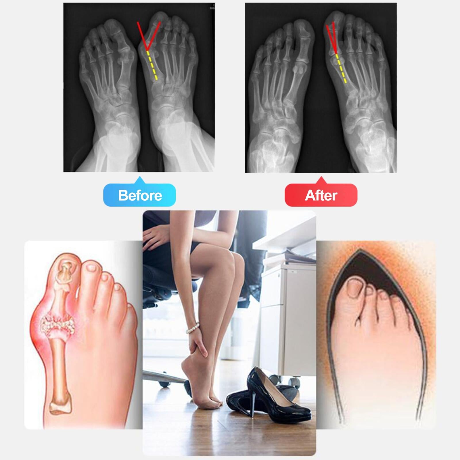 Thumb Bunion Orthopedic Corrector Correction Belt Bunion Corrector  S Left