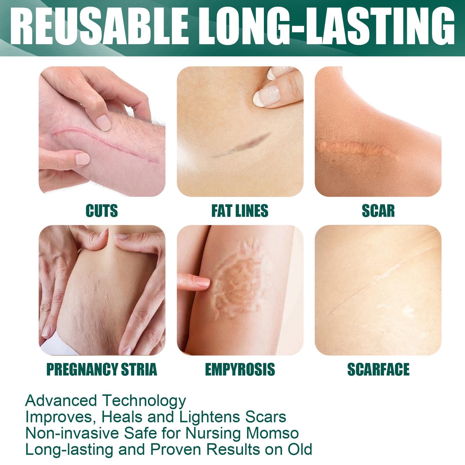 Silicone Scar Removal Sheets Soften Old and New Scars Soft 15x4cm
