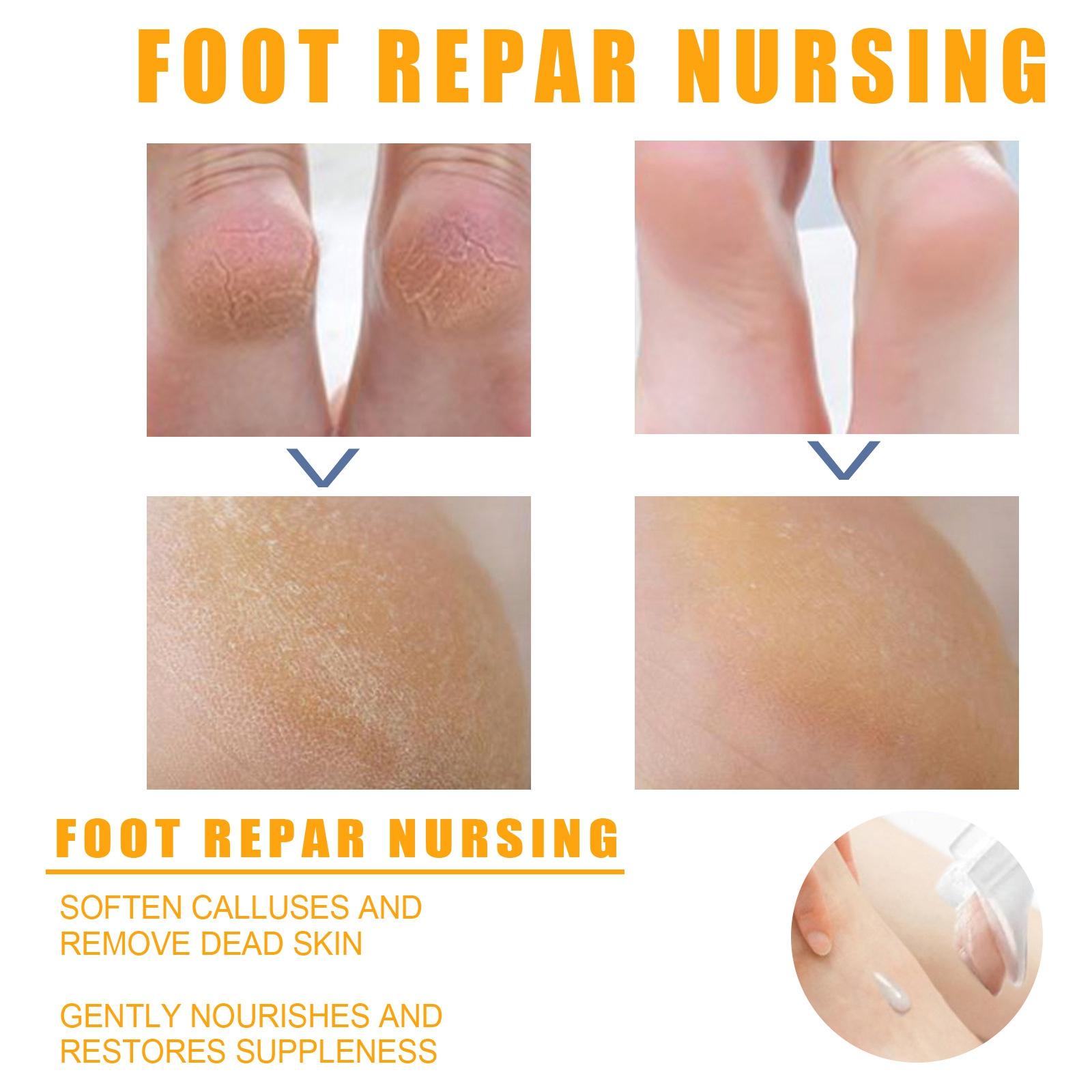 Foot Peeling Spray Hydrating Body Care Moisturzing for Feet Dead Skin  100ml
