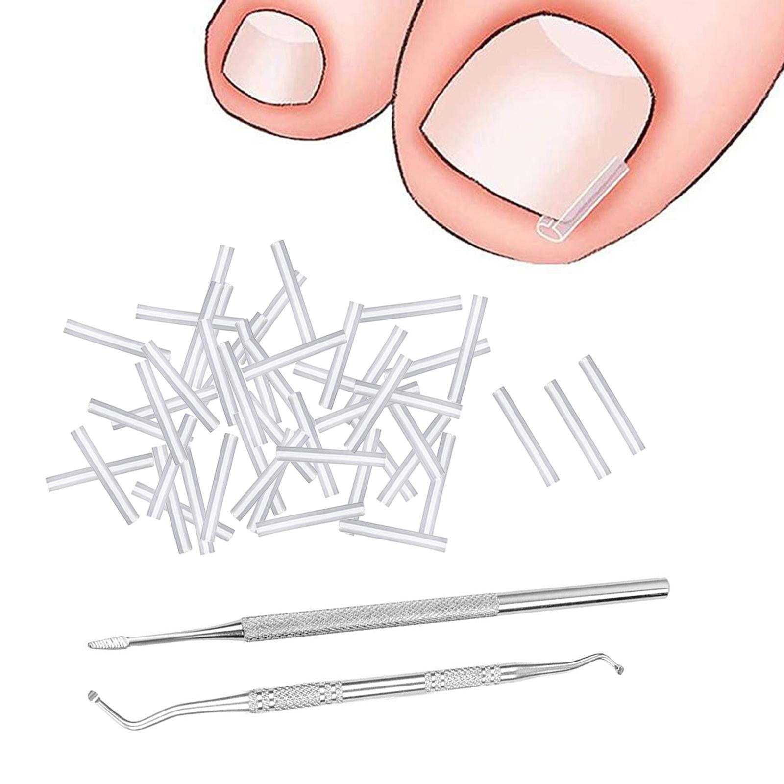 50 Pieces Ingrown Toenail Corrector Strips Nail Groove Pad Lifter Men