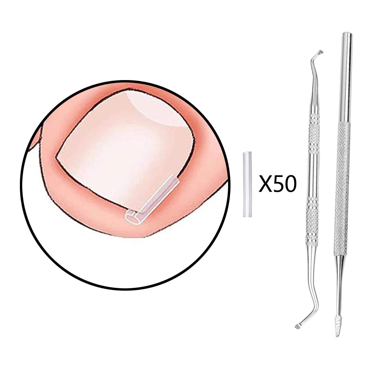 50 Pieces Ingrown Toenail Corrector Strips Nail Groove Pad Lifter Men
