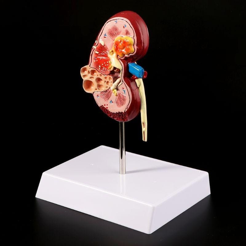 Nephropathy Model Kidney Pathology Nephrolithiasis Urology Communication Model Teaching Supplies