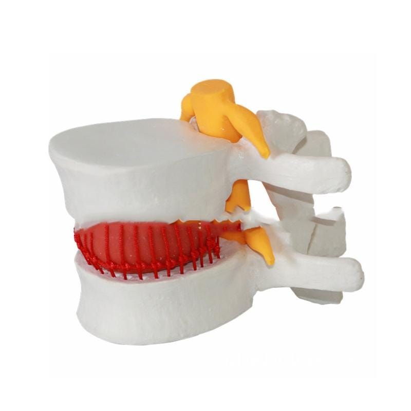 Human Lumbar Disc Herniation Demonstration Model Orthopedic Spine Model (White)