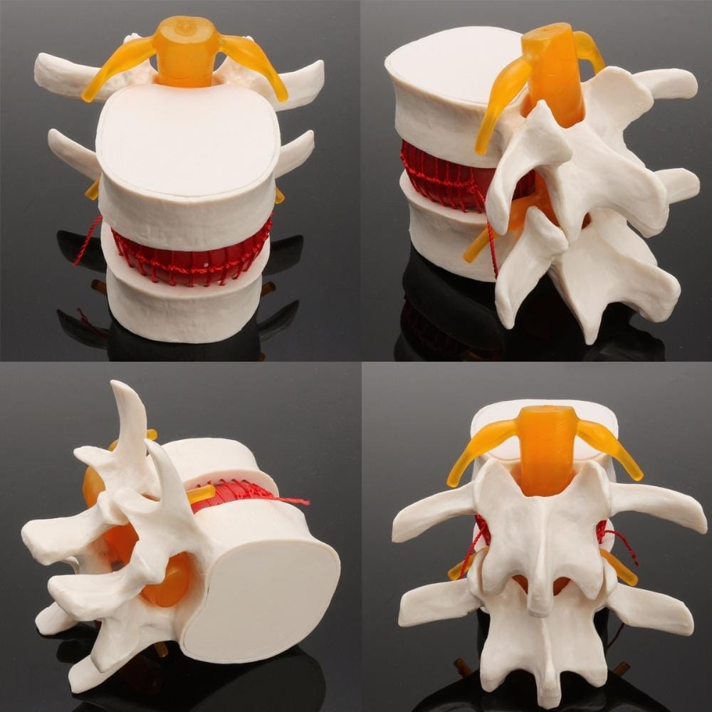 Human Lumbar Disc Herniation Demonstration Model Orthopedic Spine Model (White)
