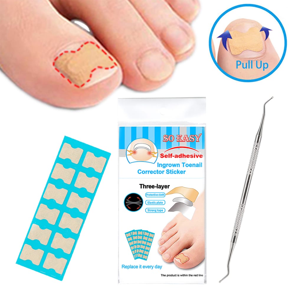 Ingrown Nail Correction Kit Ingrown Toenail Stickers 36pcs Uniqbuy